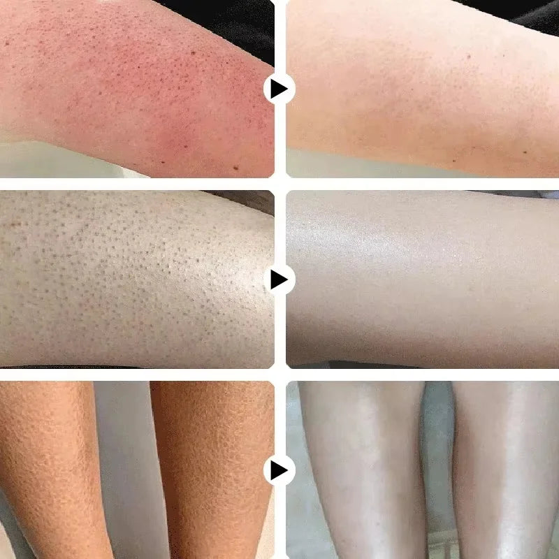 Keratosis Pilaris Repair Treatment Cream Exfoliating Removal