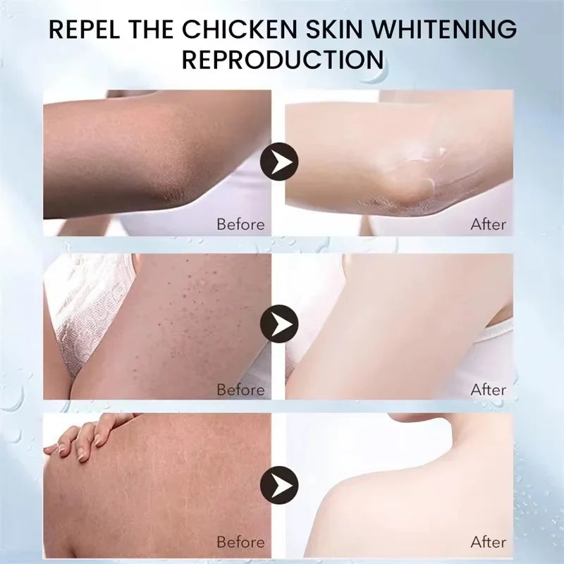 Keratosis Pilaris Repair Treatment Cream Exfoliating Removal